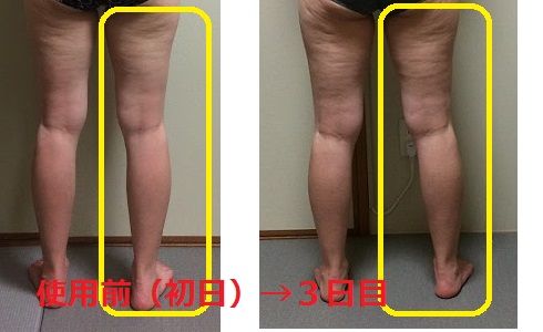 リファカラットvs40歳セルライト 3日目 リファカラットvs40歳セルライト リファカラットvs40歳セルライト 3日目 リファカラットvs40歳セルライト