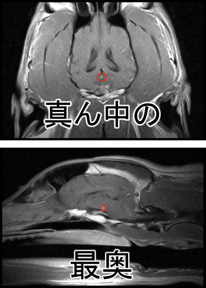 脳腫瘍について1-7