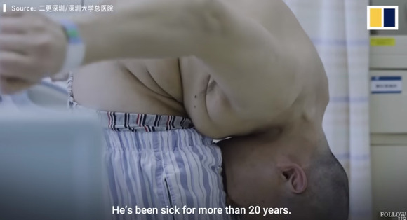 中国の『折り畳まれた男』リー・フアさんが28年ぶりにまっすぐ立つことに成功