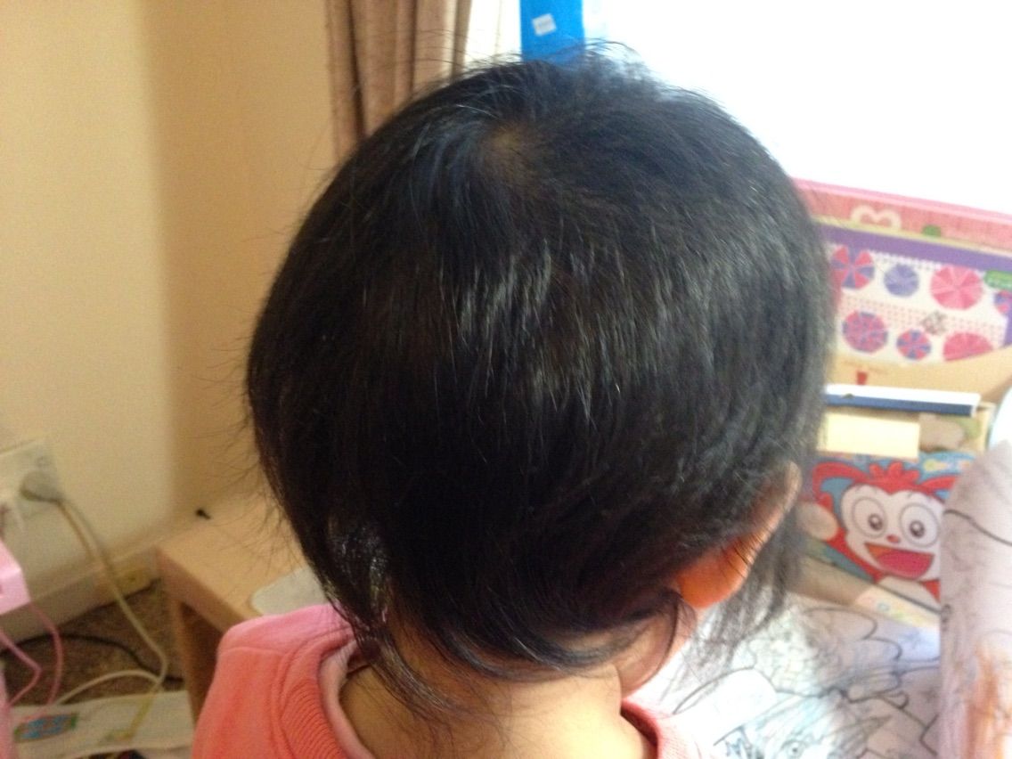 娘 髪むしりをやめて1ヶ月後 へなちょこお母さんのつぶやき 娘 髪むしりをやめて1ヶ月後 へなちょこお母さんのつぶやき