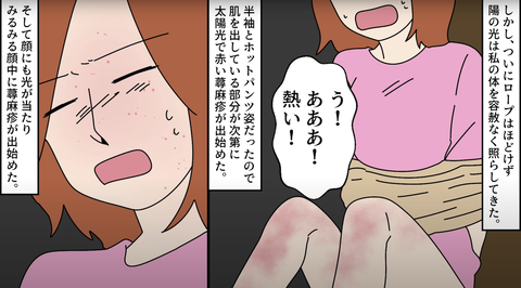 日光アレルギー18