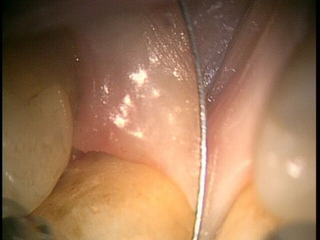 20.1.25 右下8番近心 歯石除去 後