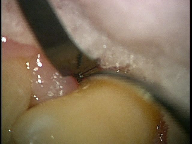 SRP3