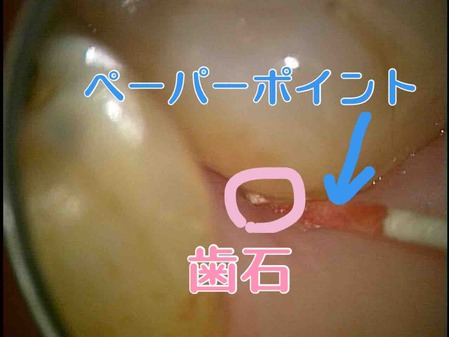 イクロリトラクションテクニック歯石の明確化
