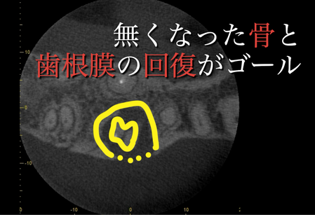 歯槽骨の回復