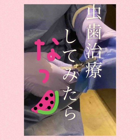 2023.08.12.虫歯治療