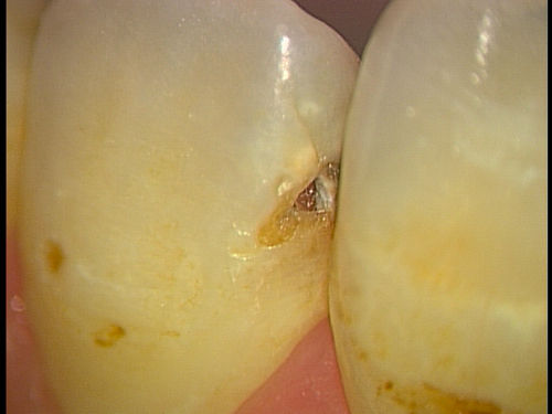 caries2
