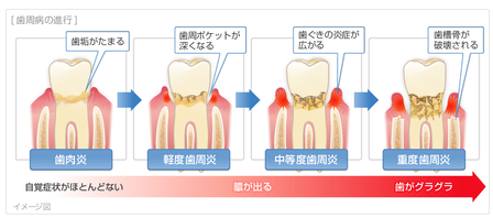 歯周病の進行