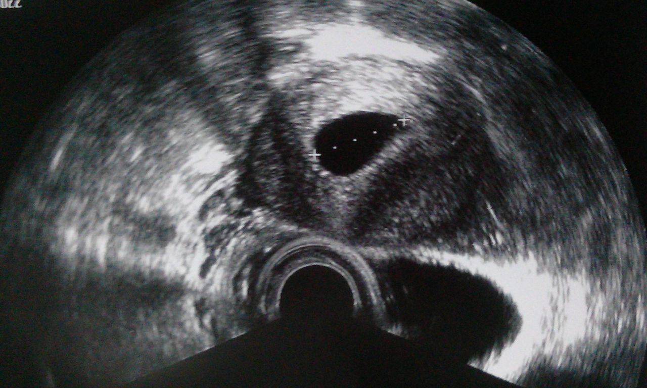 のみ 胎嚢 6 週