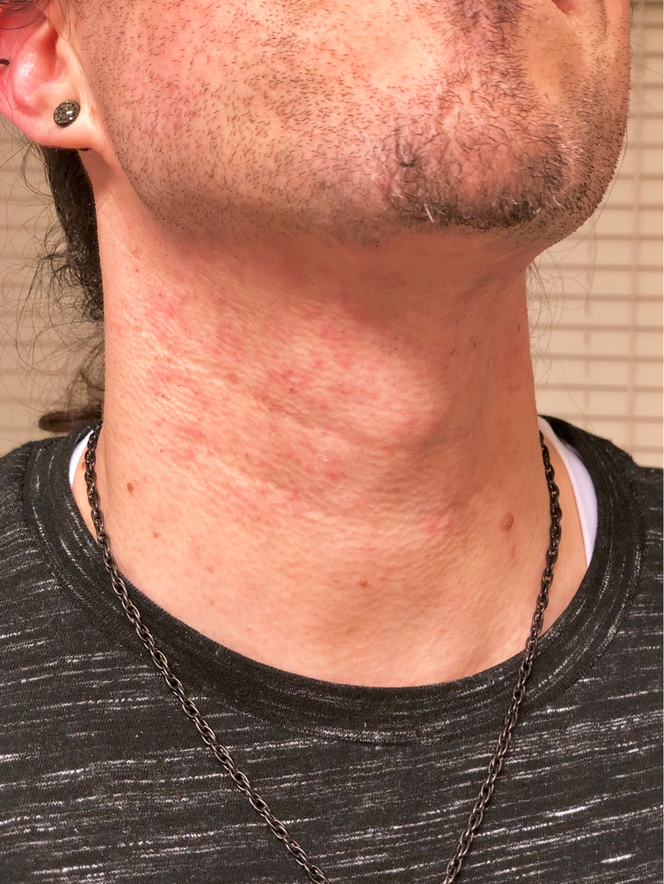 夫 髭をレーザー脱毛で除去 Marriage Life In Arizona アリゾナで国際結婚 Powered By ライブドアブログ