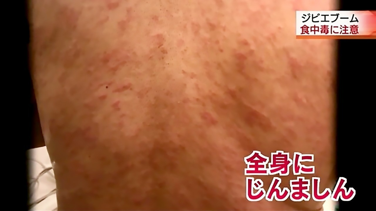 熊 肉 寄生 虫