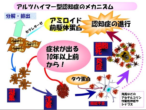 アミロイド仮説