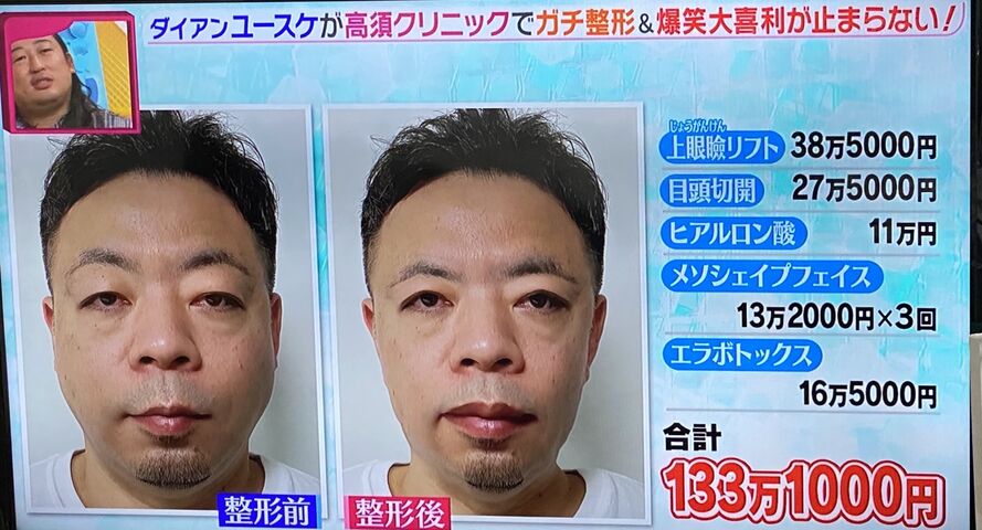 速報 ダイアンユースケ 整形wwwww 画像あり 2chニュースのまとめのまとめ 速報 ダイアンユースケ 整形wwwww 画像あり 2chニュースのまとめのまとめ