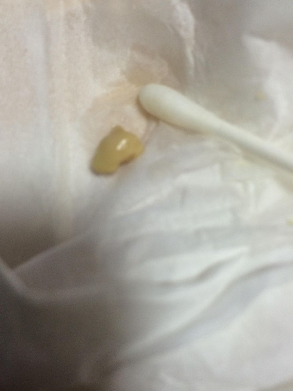 でかっ くさい臭い玉とれた 膿栓 口臭 膿栓のトラブルを解決する方法