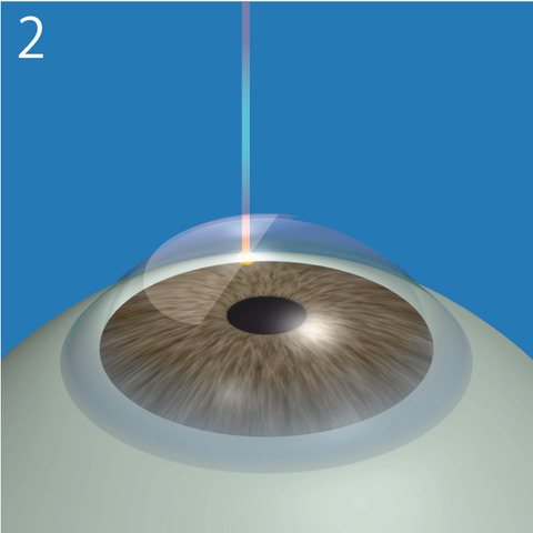 LASIK_ope2