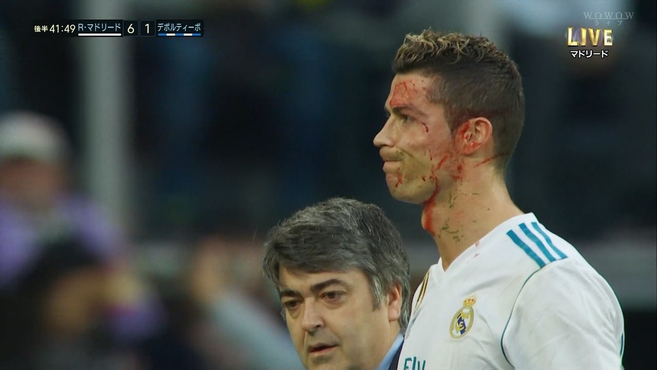 画像 動画 閲覧注意 試合中に顔面から流血したクリロナさん スマホで顔を確認www フットバル