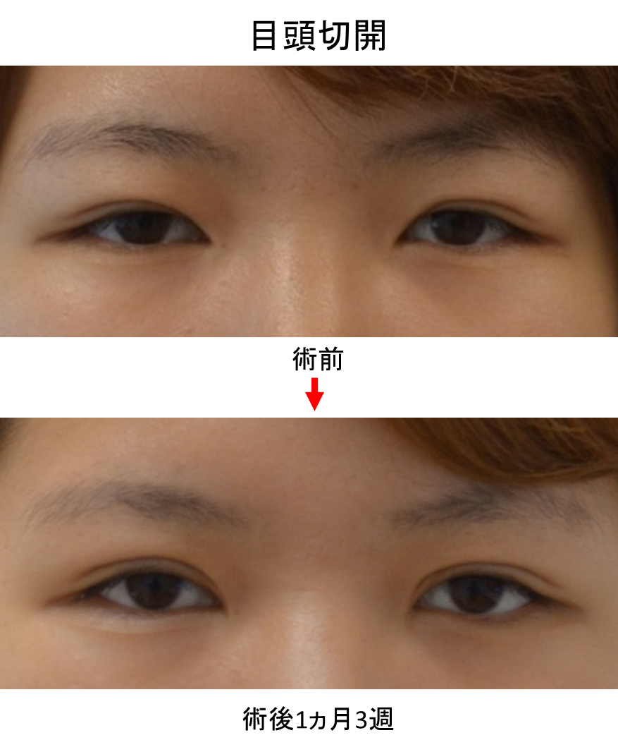 目頭切開 松下皮フ形成外科 院長日記