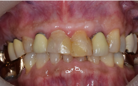 ベニアビフォー