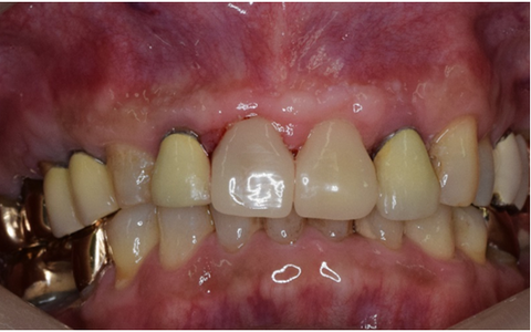 ベニアアフター