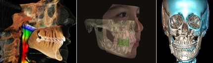 3Dデジタル矯正