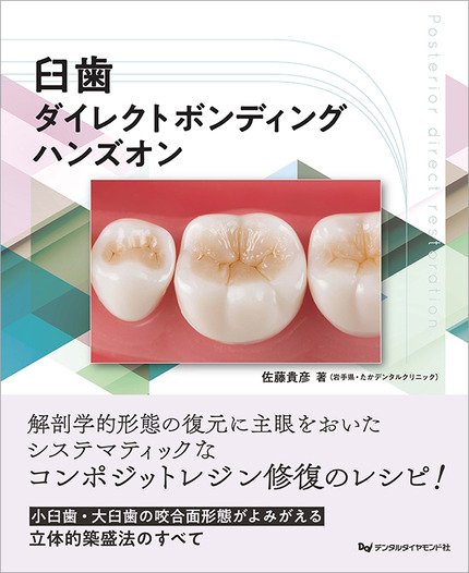 臼歯ダイレクトボンディング