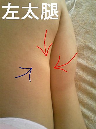 画像アリ 謎のしこり 妊娠線 肉割れ ストレッチマークが ﾉd 授かりもの日記