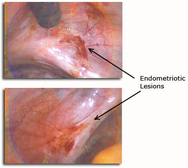 Endo1