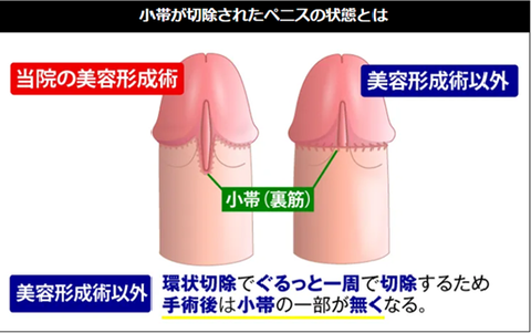 性感帯小帯の切除