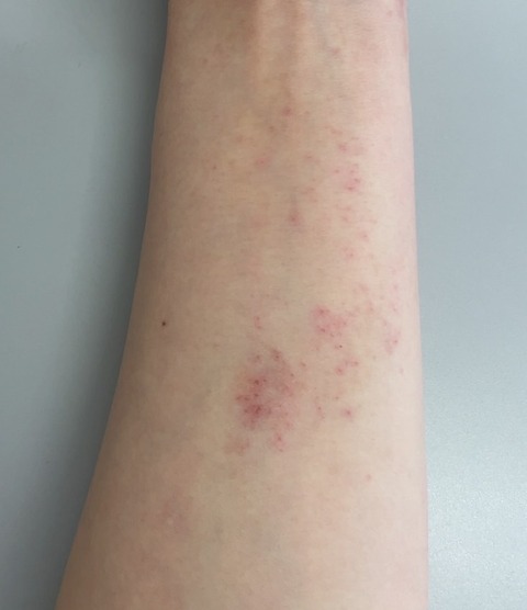 atopy before(O)
