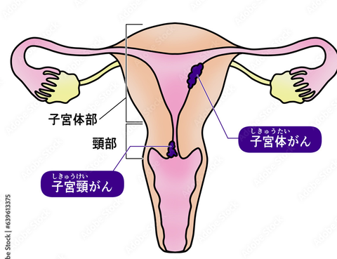 子宮頸がんイラスト図