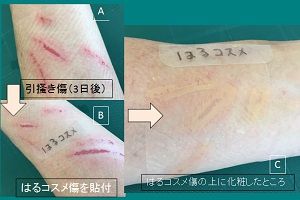 8 はるコスメ 傷 ハイドロコロイド