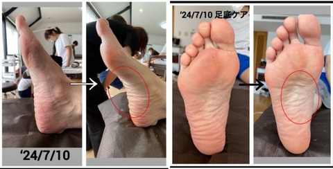 足底ケア実践報告写真