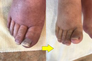 むくみの改善事例1