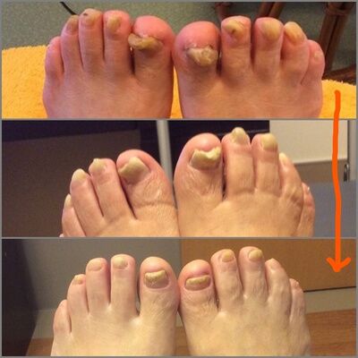 爪ケア_実践報告1-thumb-400x400-933