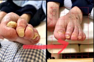 肥厚爪事例2