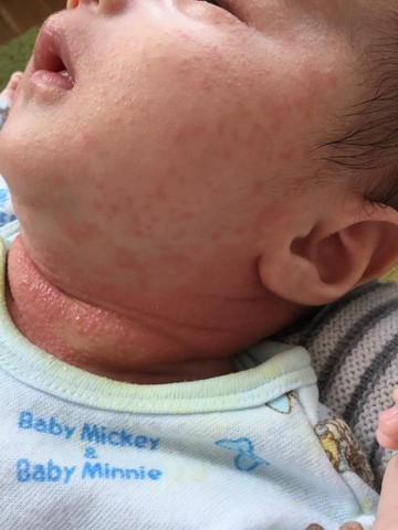 生後１ヵ月 咳と首のただれ Meguのまいにち記録 ４児ままの育児日記