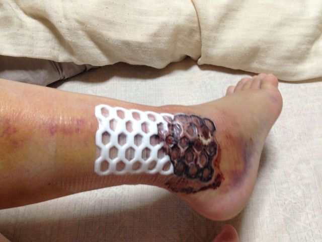 6 25 木 骨折8日目 手術3日目 退院 足首骨折闘病日記