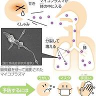 マイコプラズマ肺炎の現状：過去最多の患者数とその影響