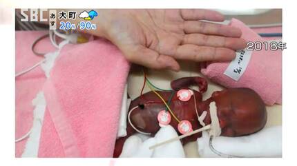 258gから11.7kgへ: 世界最小の赤ちゃんの奇跡の成長記録