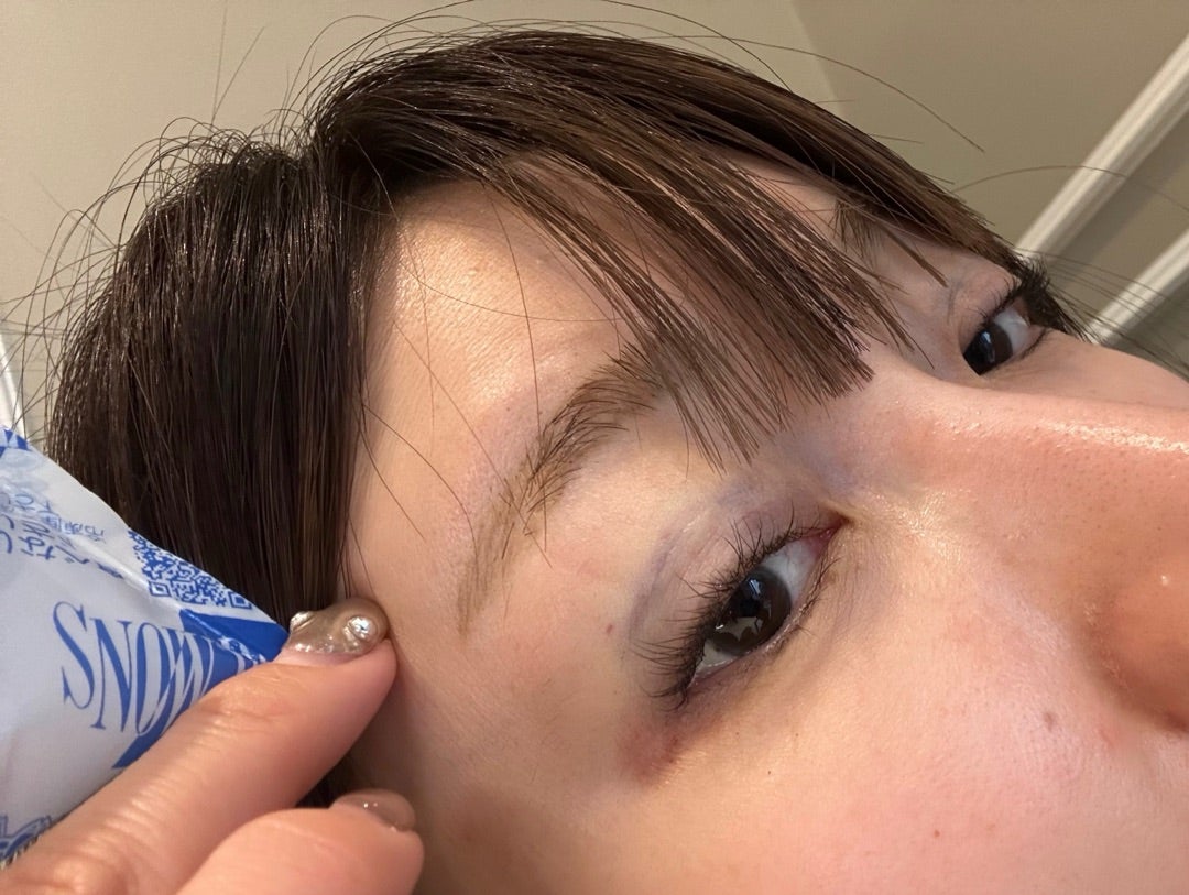 3度の二重整形！桃（40）の韓国美容施術ビフォアフまとめ！ハプニングも発生！