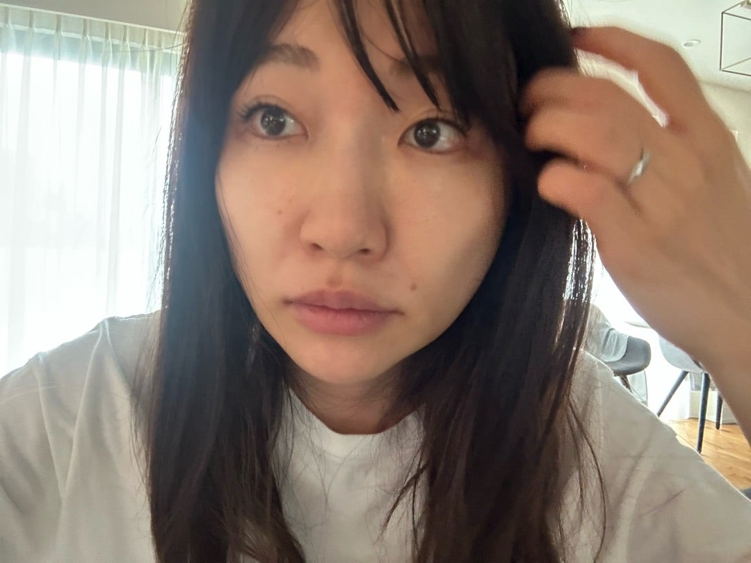 あいのり・桃、脂肪吸引手術後の顎下の腫れに驚き！