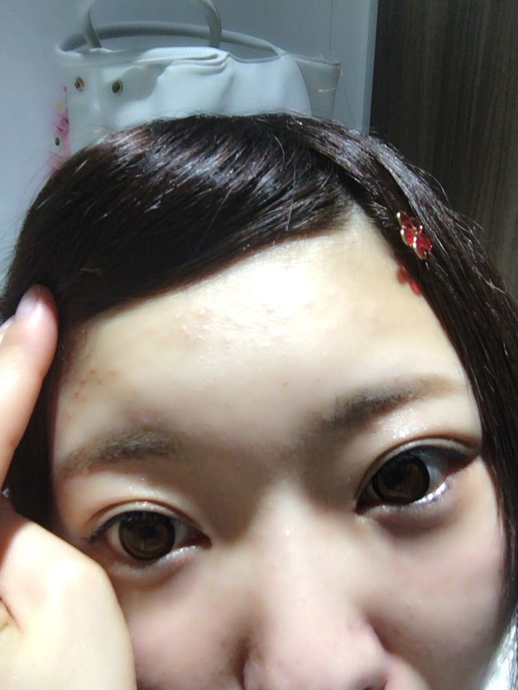 にきび 愛内陽菜のblog にきび 愛内陽菜のblog