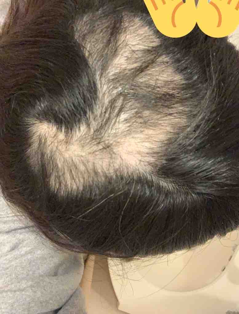 画像あり 今の髪の毛の状況 抜毛症と向き合う女