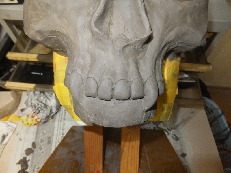 骸骨メット さし歯編 モトファクトリーガルムの日記