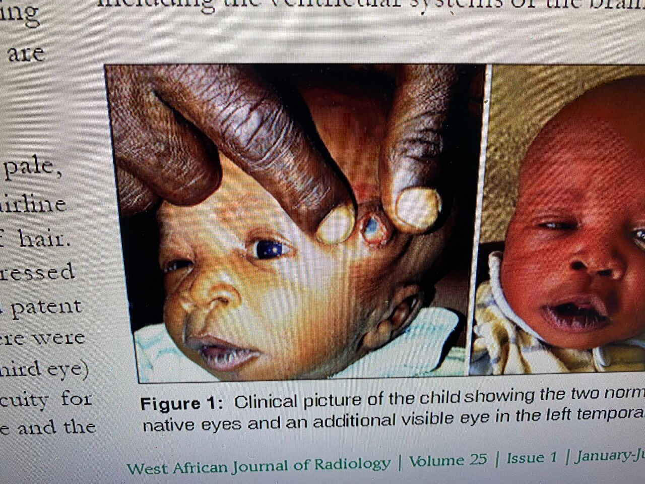 3-eyed infant