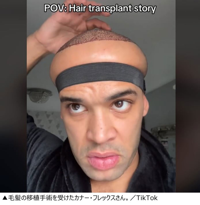 【悲報】ロンドンのクリニックで植毛手術を受けた男性、副作用で頭が巨大化する