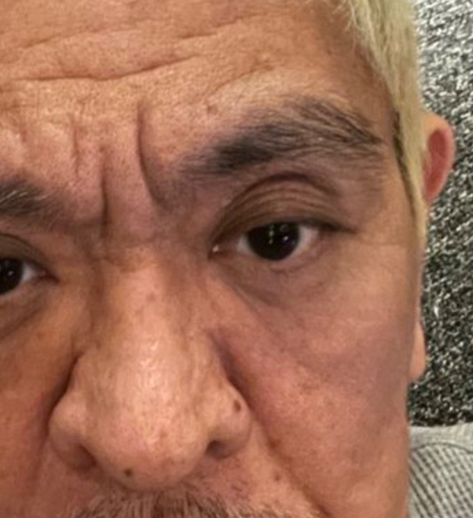 【画像】松本人志さん、五重まぶただった