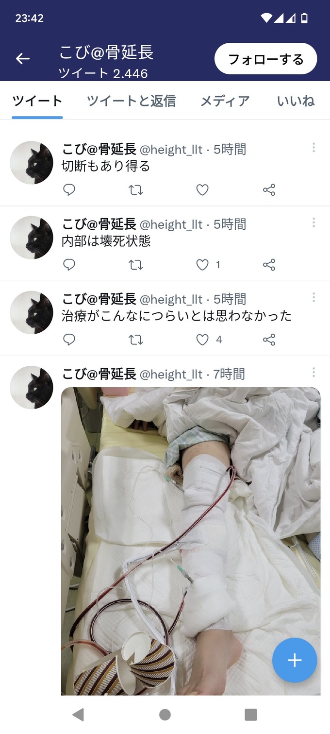 【悲報】身長を伸ばすために骨延長手術を受けた男性、骨髄炎で壊死・切断か…　たぬかなどうすんの？