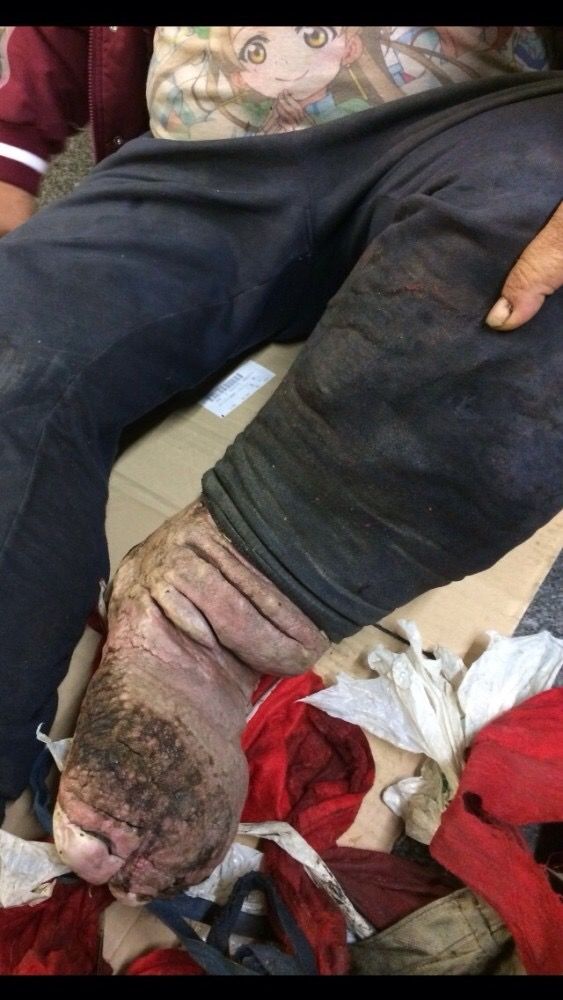 もみあげチャ シュ 超閲覧注意 左足壊死ニキ ついに左足の封印を解く ライブドアブログ もみあげチャ シュ 超閲覧注意 左足壊死ニキ ついに左足の封印を解く ライブドアブログ