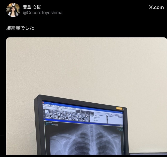 グラビアアイドルさん、レントゲン写真をアップするも“アレ”が透けて見えてしまう